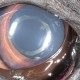 Des poils dans l’œil... un cas de dermoïde conjonctival et persistance de membrane pupillaire