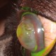 Perforation oculaire traitée par une greffe de péricarde bovin - Tutopatch