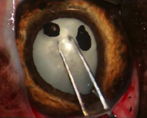 chirurgie cataracte extracapsulaire