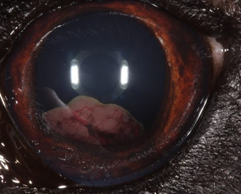 Adénome corps ciliaire