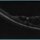 Décollements rétiniens et virus de la PIF, intérêt de la tomographie en cohérence optique (OCT)